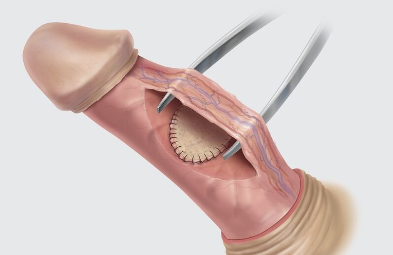 Chirurgie fir Erliefnes Erweiderung
