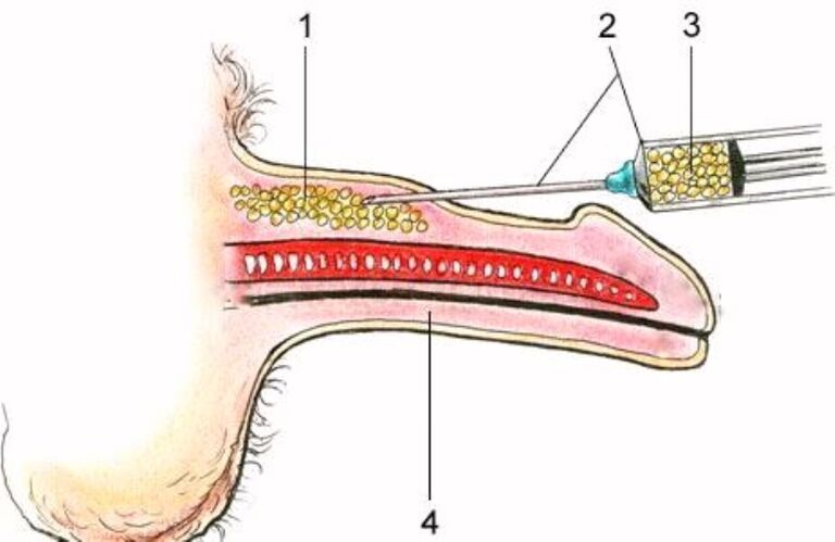 Injektioun Penis Erweiderung