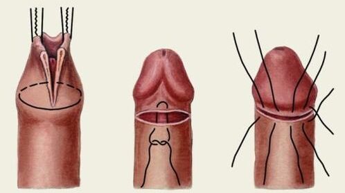 Wéi gëtt penile Plastesch Chirurgie gemaach